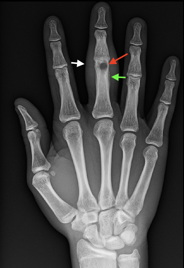 Acute Osteomyelitis, Plain Radiograph