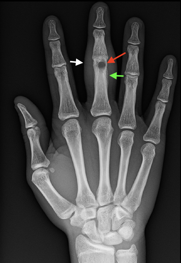 Osteomyelitis Imaging Treatment Management Point of Care