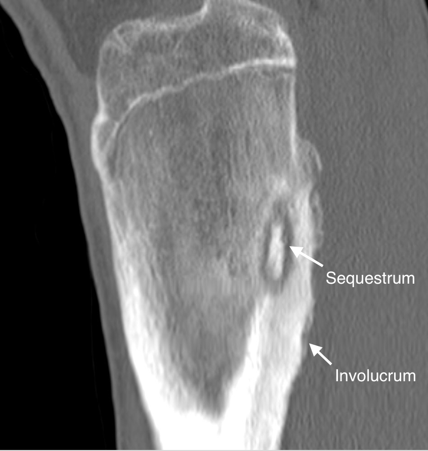 Chronic Osteomyelitis, Computed Tomography