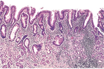 <p>Histopathology of Chronic Gastritis.&nbsp;This slide shows gastric mucosal atrophy with high lymphocytic infiltrate.</p>