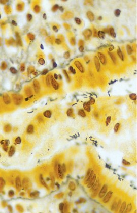 <p><em>H. pylori</em>&nbsp;Gastritis. A spiral-shaped bacterium seen on H&amp;E staining.</p>