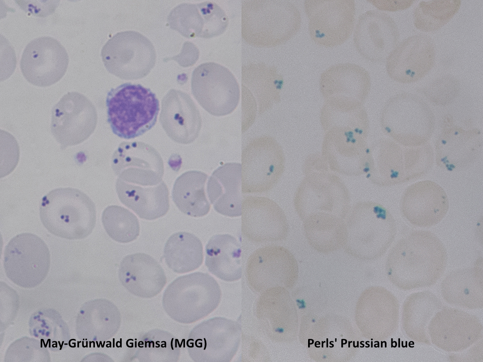 Pappenheimer bodies within RBCs appear as pyknotic violet dots (MG Giemsa stain) and appear blue with Perl's Prussian blue stain for iron