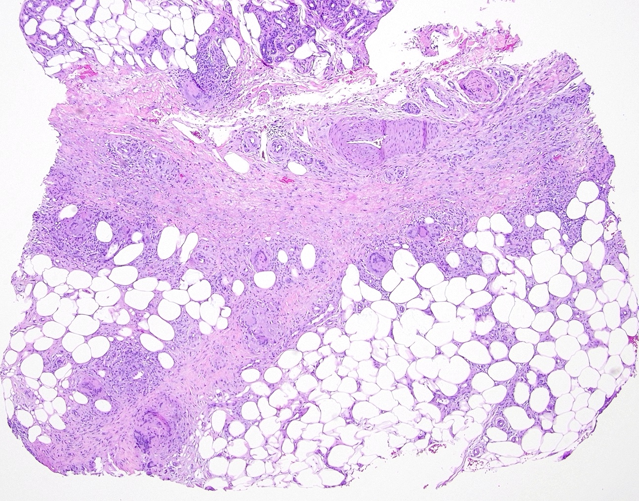 <p>Erythema Nodosum, Low Power