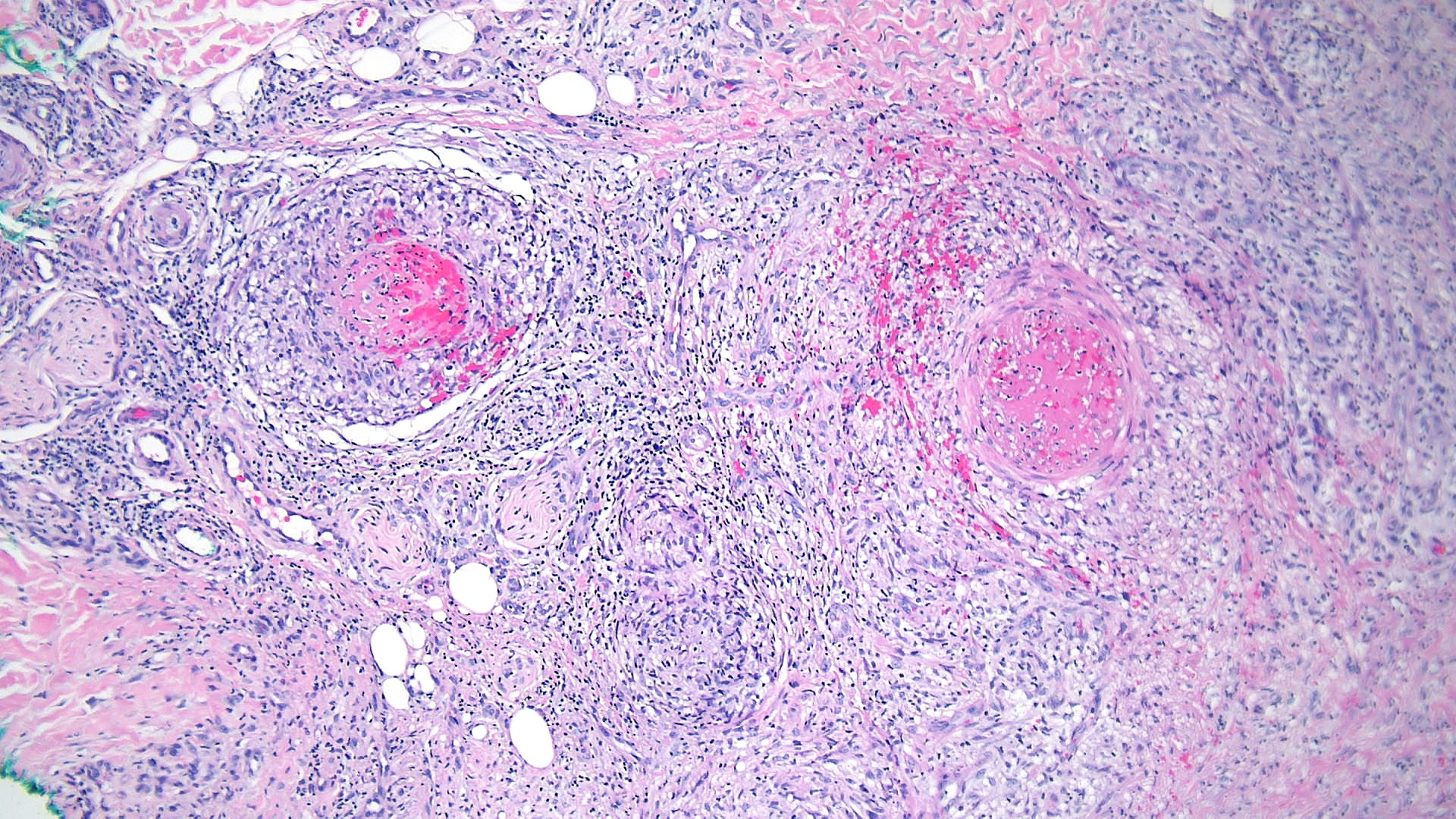 <p>Erythema Induratum of Bazin