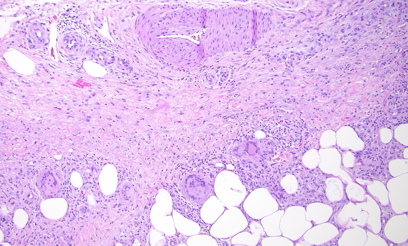 <p>Erythema Nodosum, High Power