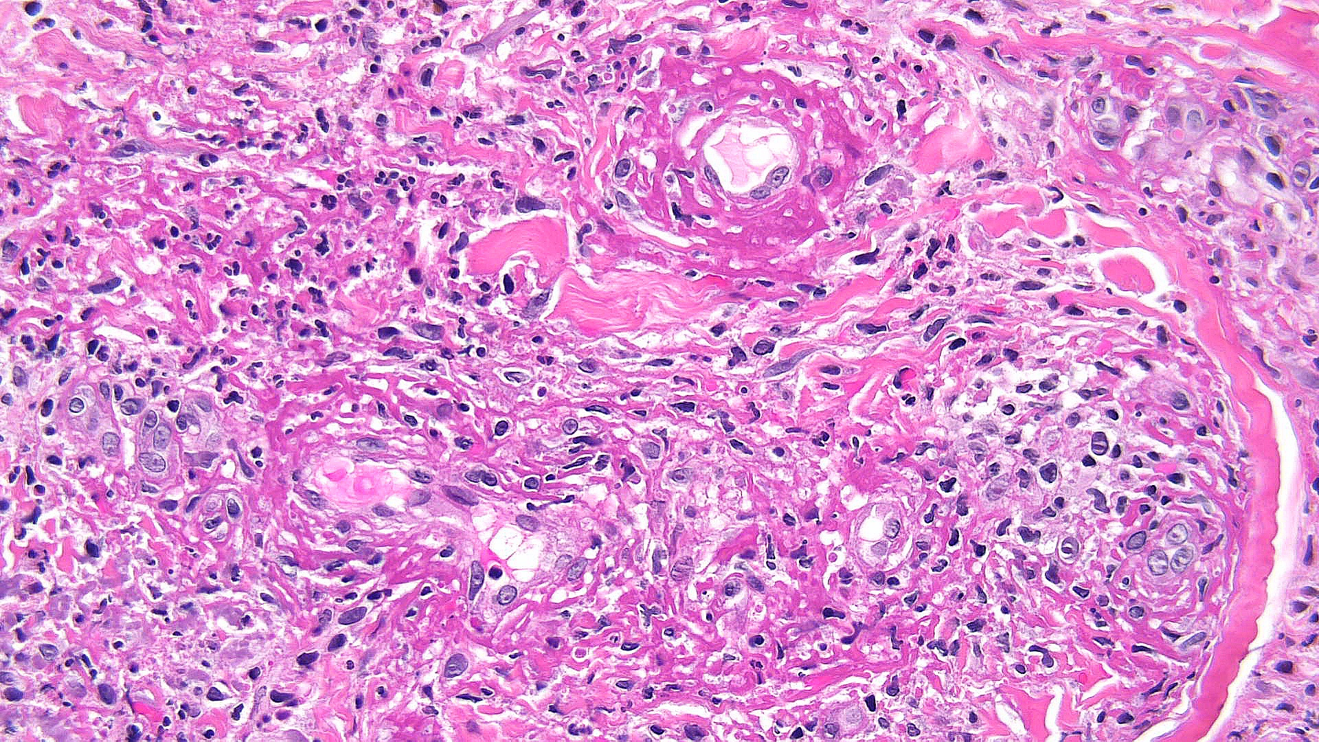 <p>Leukocytoclastic Vasculitis Pathology