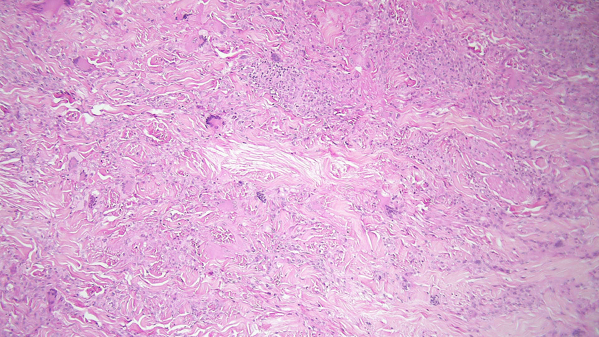 <p>Necrobiotic Xanthogranuloma Pathology, Low Power