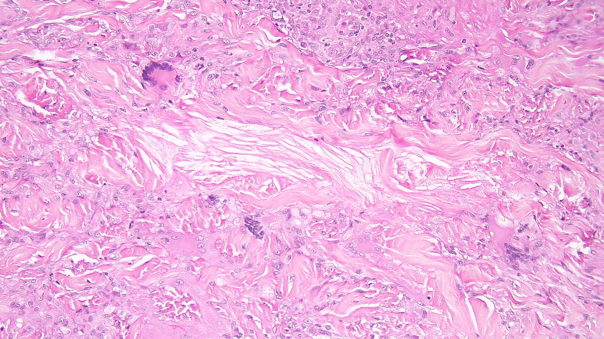 <p>Necrobiotic Xanthogranuloma Pathology, High Power