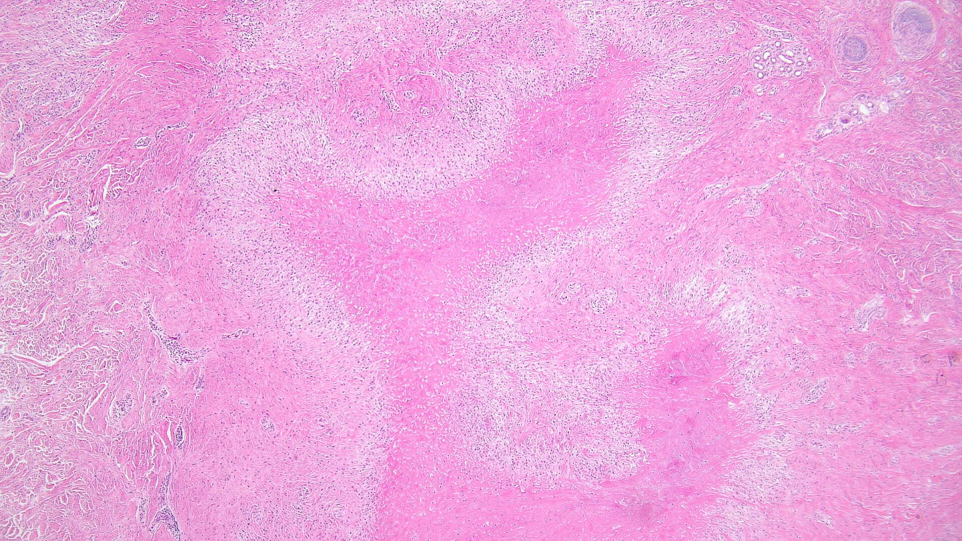 <p>Rheumatoid Nodule Pathology