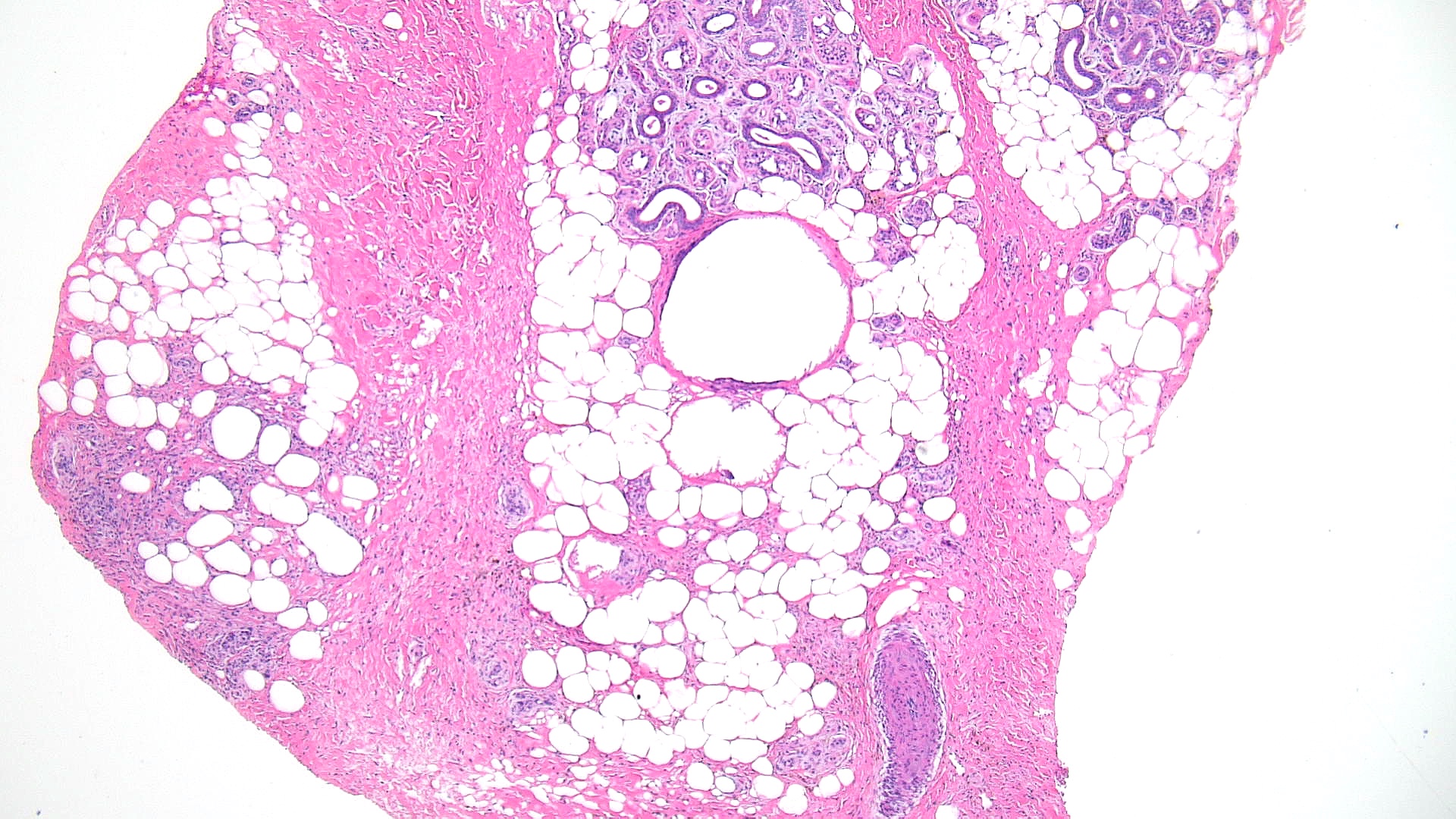 <p>Sclerosing Panniculitis, Low Power