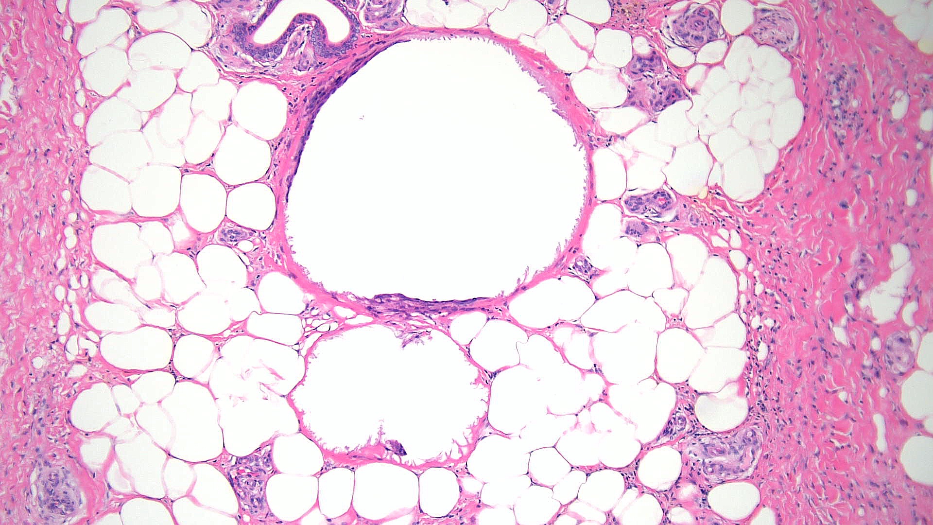 <p>Sclerosing Panniculitis, High Power