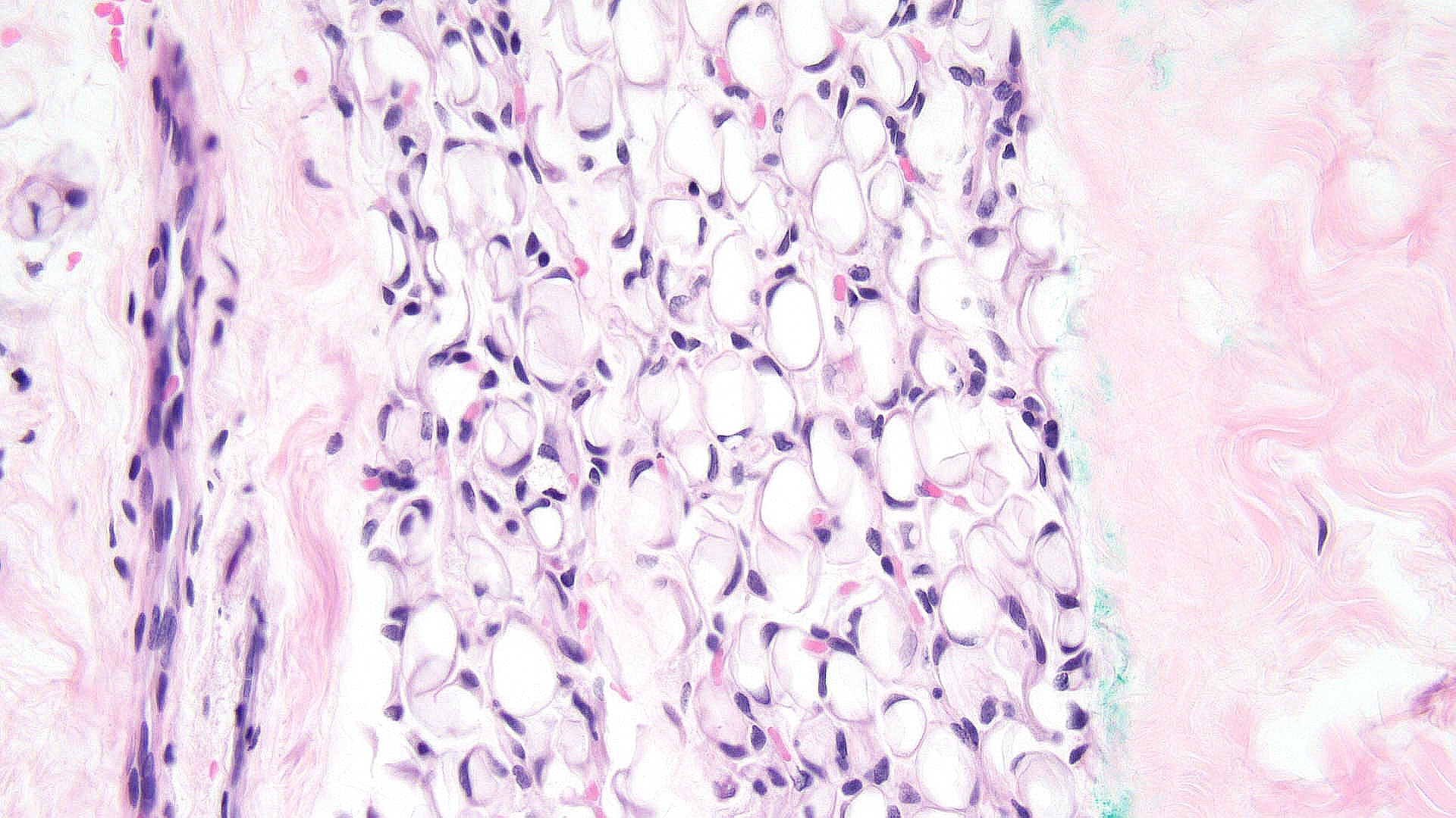 <p>Post-steroid Panniculitis Pathology. Histopathology shows less inflammation and fewer needle-shaped clefts.</p>