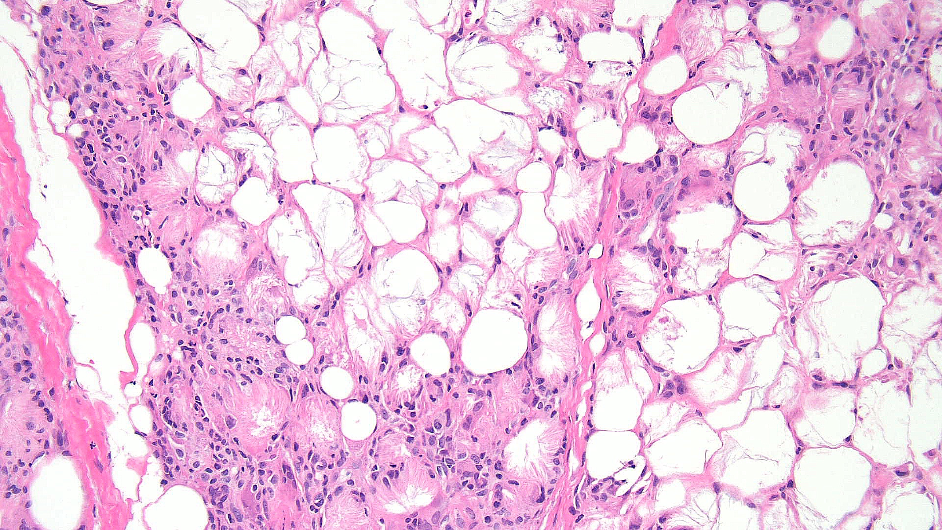 <p>Subcutaneous Fat Necrosis of the Newborn, Low Power