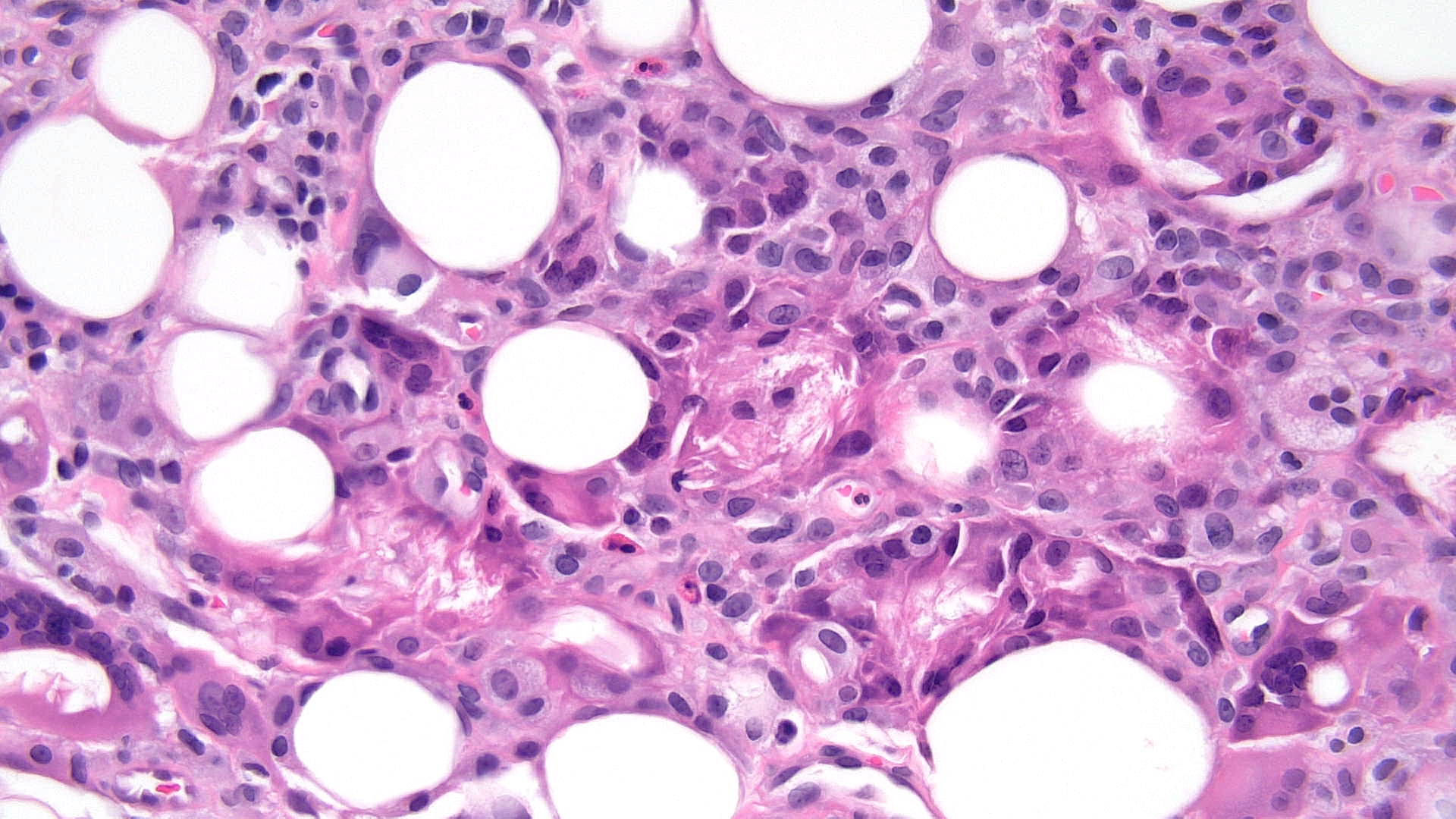 <p>Subcutaneous Fat Necrosis of the Newborn, High Power