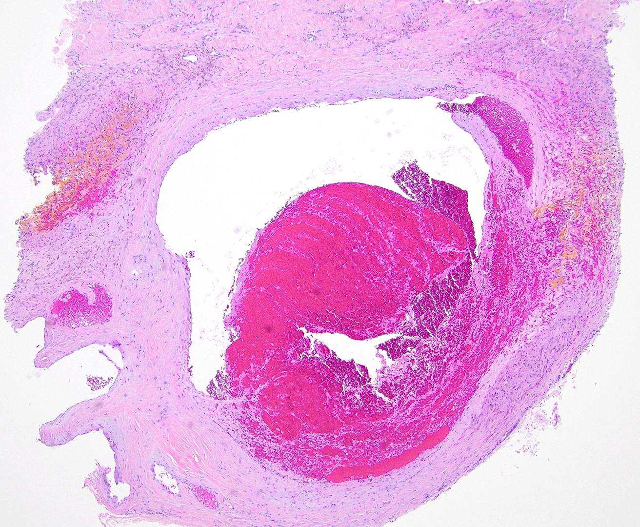 <p>Thrombophlebitis Pathology. The histopathology reveals vasculitis and thrombosis occluding the lamina.</p>