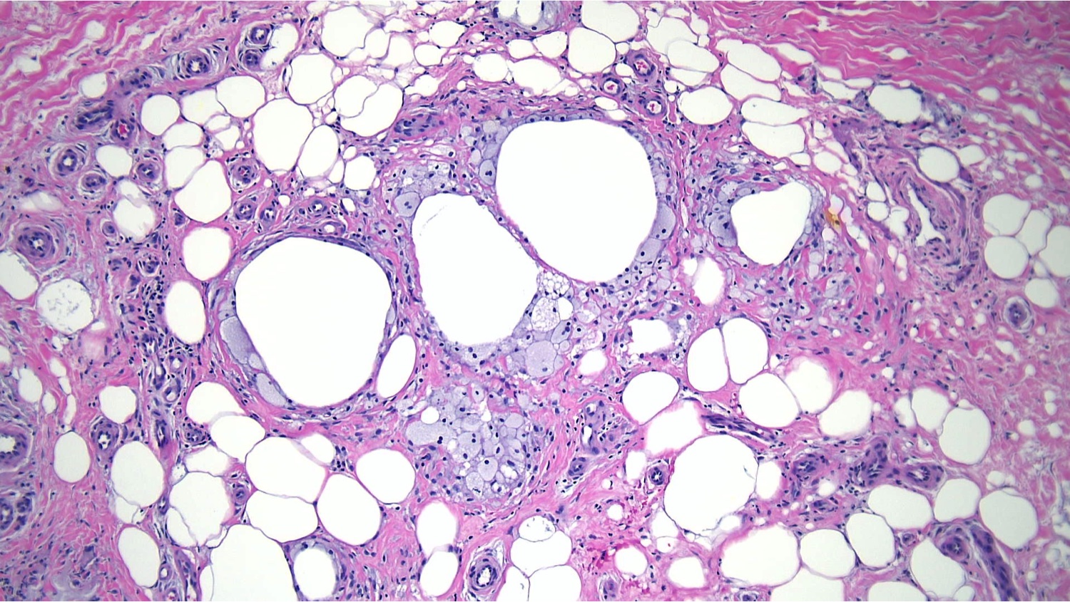 <p>Traumatic Panniculitis Pathology