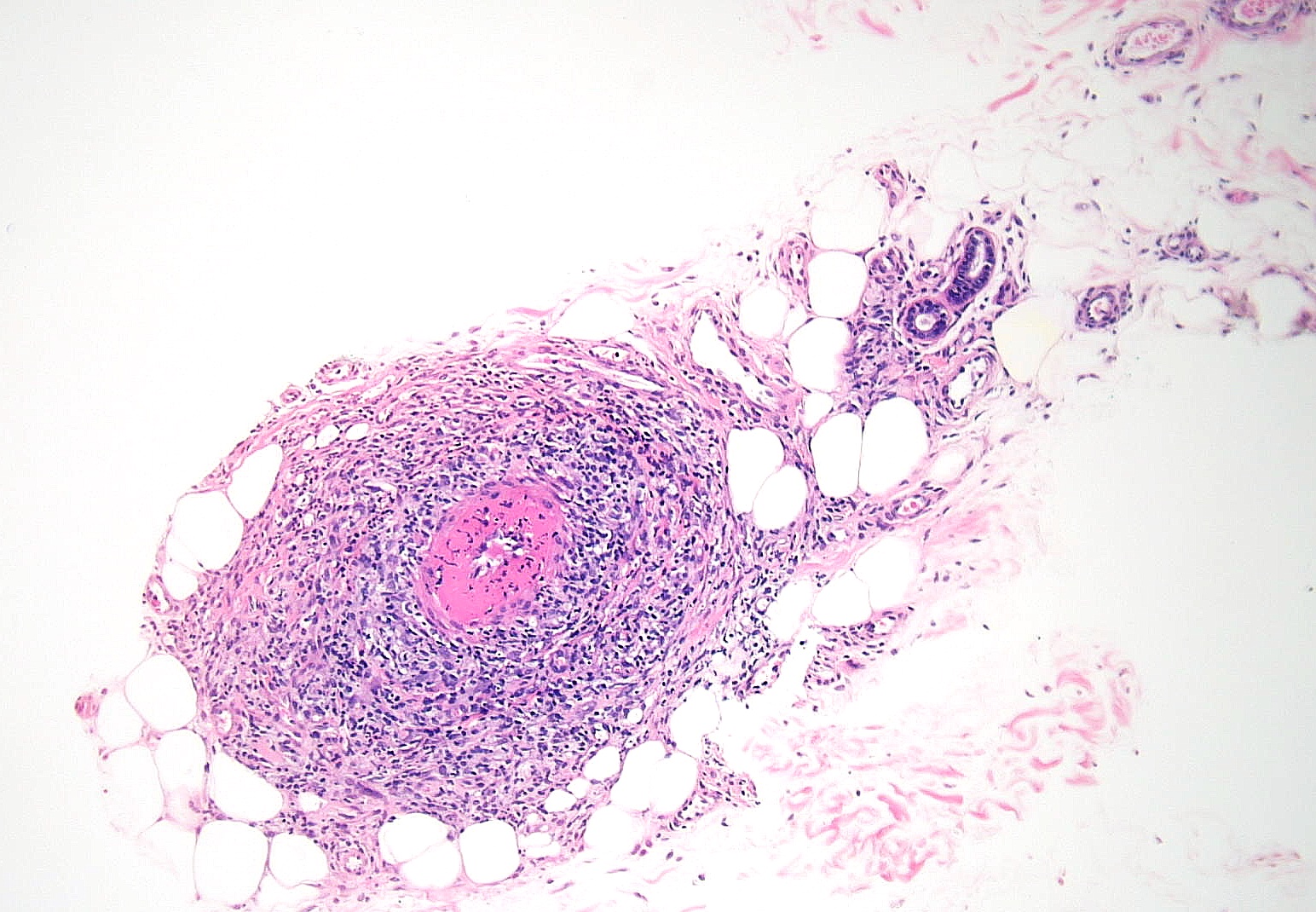 <p>Polyarteritis Nodosa Pathology