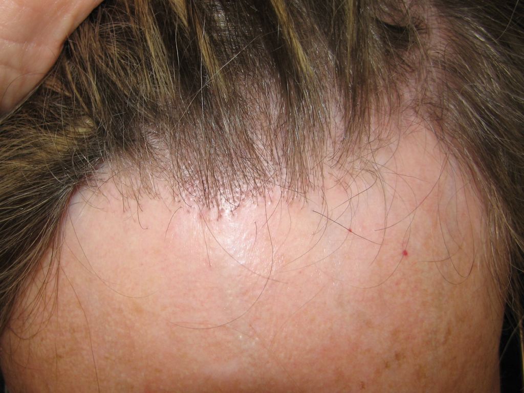 <p>Frontal Fibrosing Alopecia