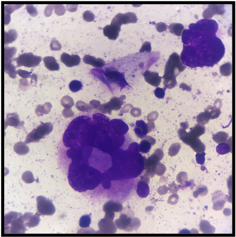 <p>Dysplastic Megakaryocytes. Bone marrow aspirate showing scattered dysplastic megakaryocytes.</p>