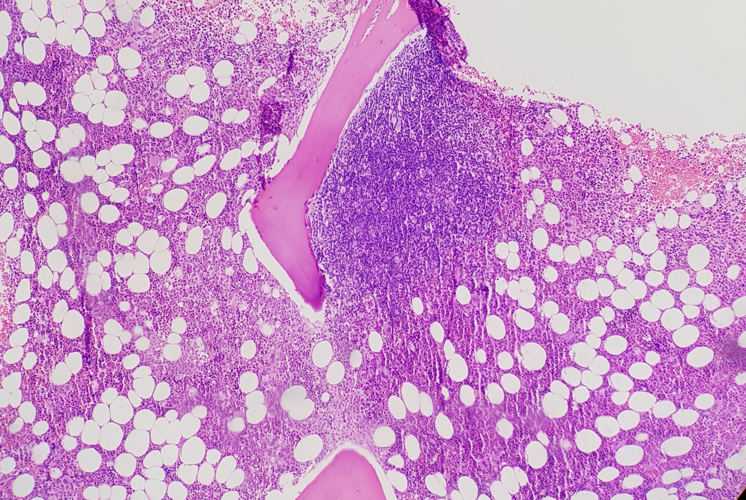 <p>Paratrabecular Lymphoid Aggregate. This bone marrow biopsy shows paratrabecular lymphoid aggregation.</p>
