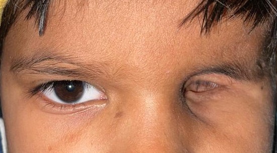 <p>Post-Enucleation Anophthalmia