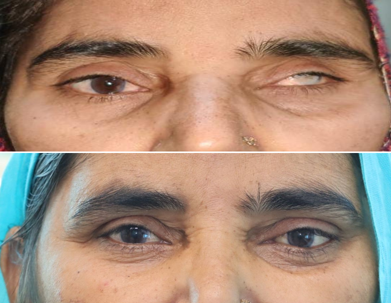 <p>Post-Evisceration Anophthalmia with Orbital Implant