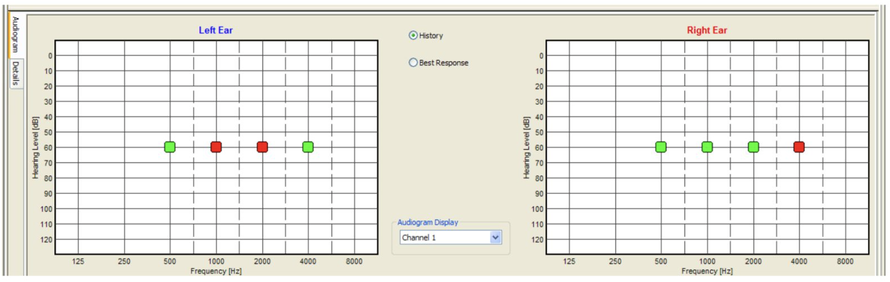 <p>Audiogram. Auditory steady-state response in an ongoing examination using MASTER application.</p>