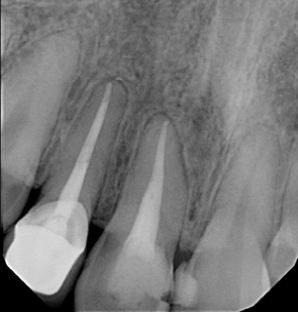<p>Periapical x-ray