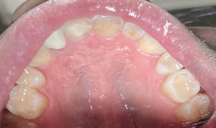 <p>Occlusal View at 6 Months