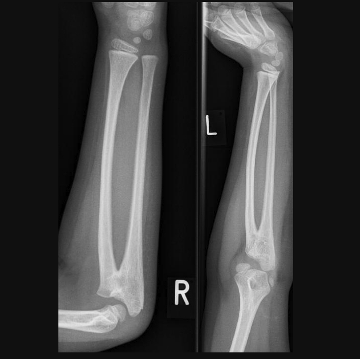 <p>Radioulnar Synostosis. Plain radiography of a congenital proximal radioulnar synostosis in a 7-year-old boy.</p>