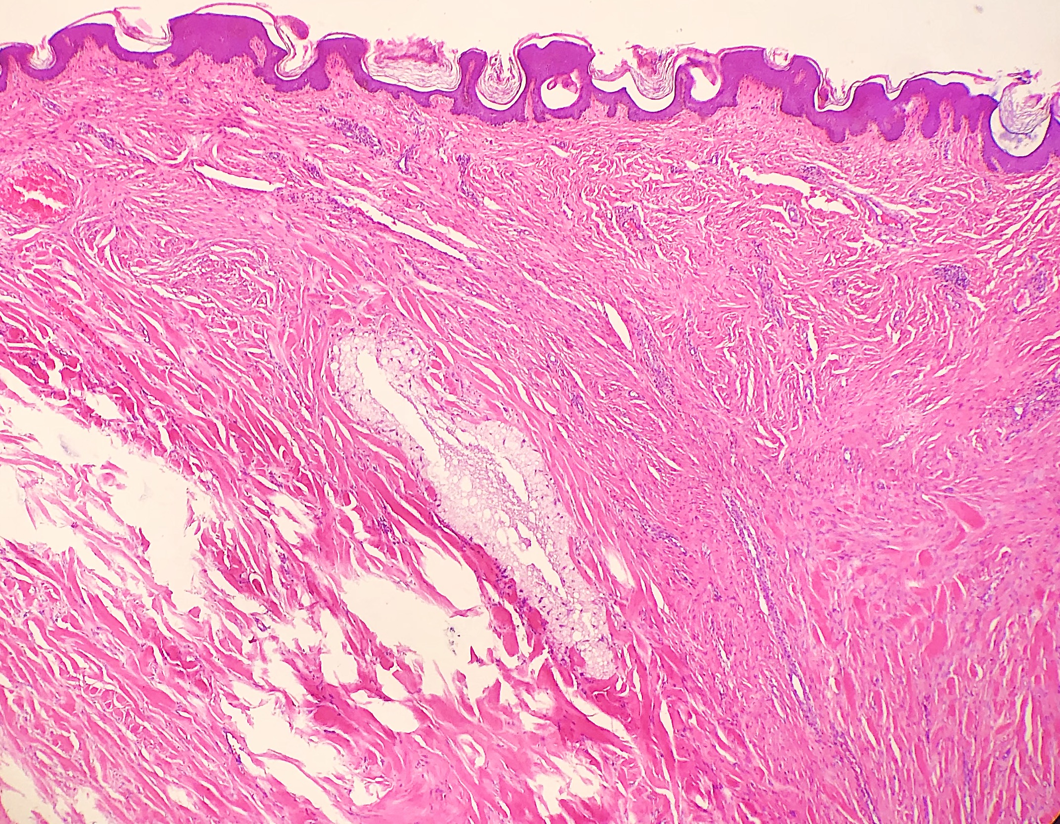 <p>Corticosteroid Keloid</p>