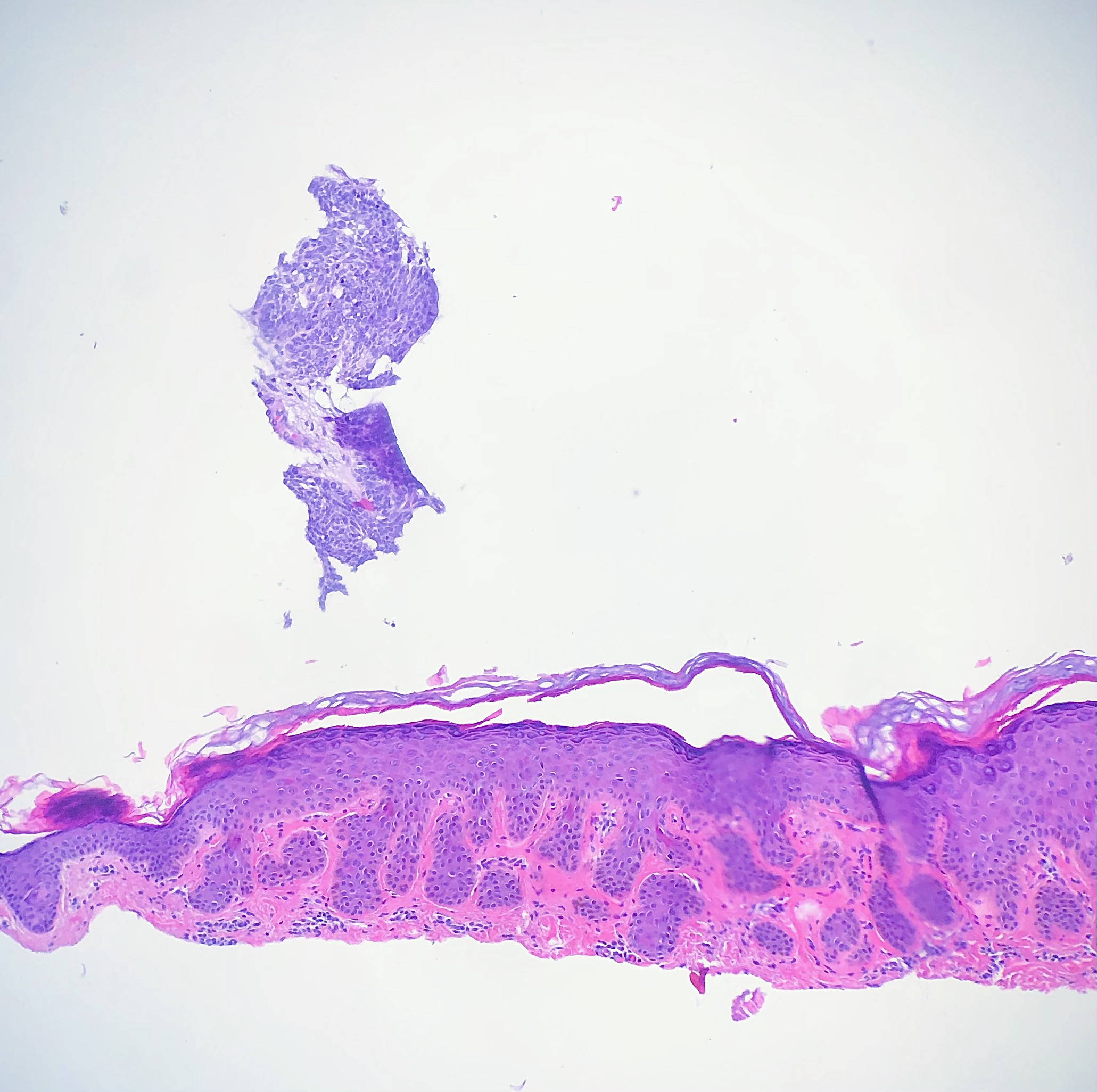 <p>Floater Artifact High Power. View of floater without relation to tissue specimen.</p>