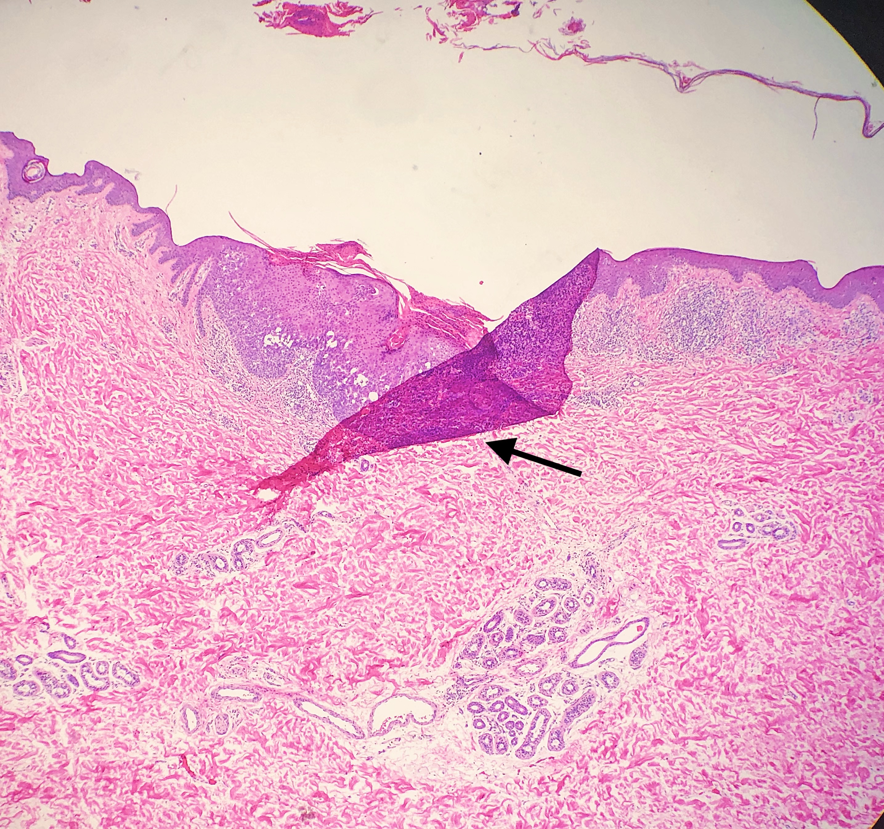 <p>Tissue Fold. Over the center portion of the epidermis extending over the papillary dermis.</p>