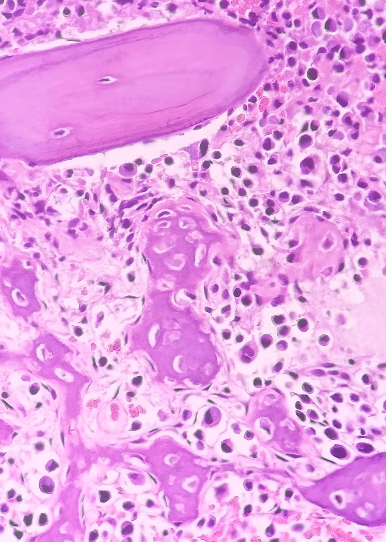 <p>Metastatic Carcinoma. Bone marrow biopsy showing infiltration by epithelial cells with signet ring morphology.</p>