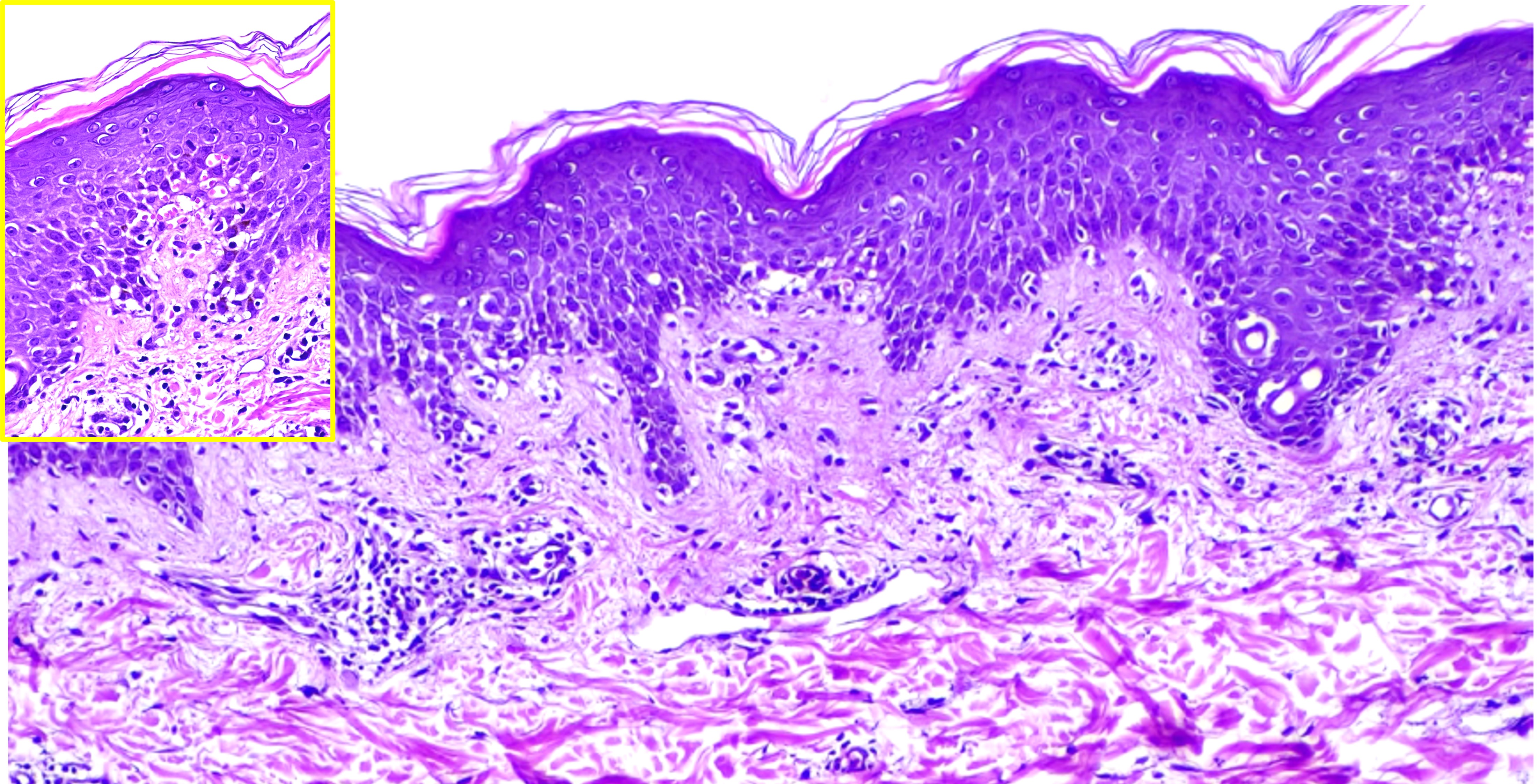 <p>Histopathology of Erythema Annulare Centrifugum