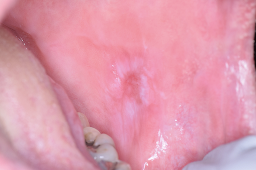 <p>Erythro-Leukoplakic Buccal Mucosal Lesion