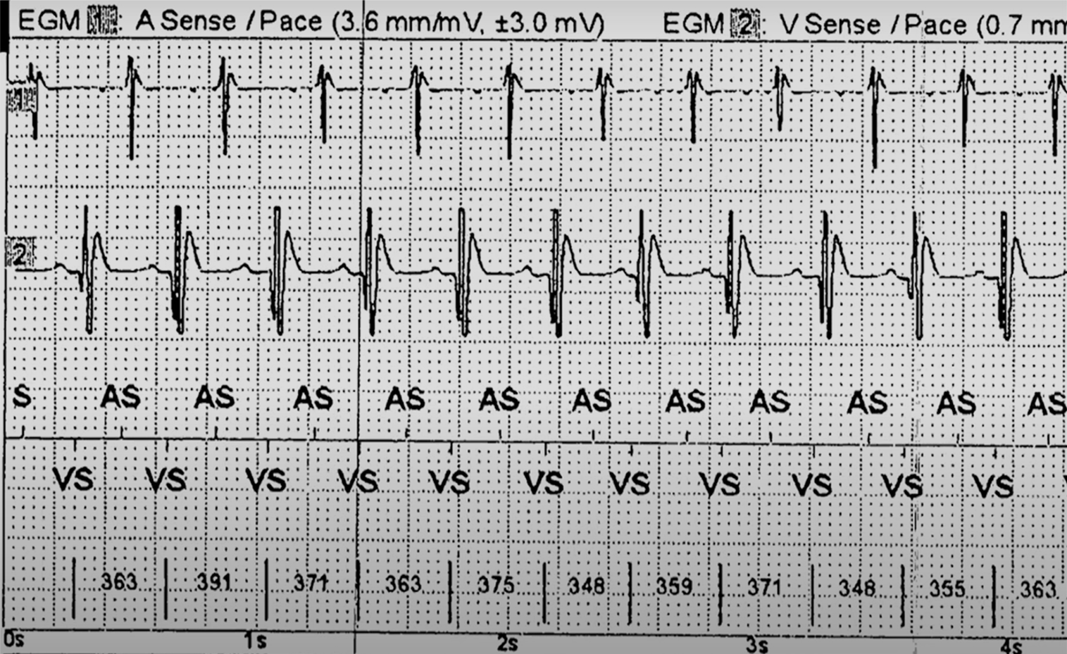 <p>Ventricular Tachycardia With 1:1 Ventriculoatrial Conduction