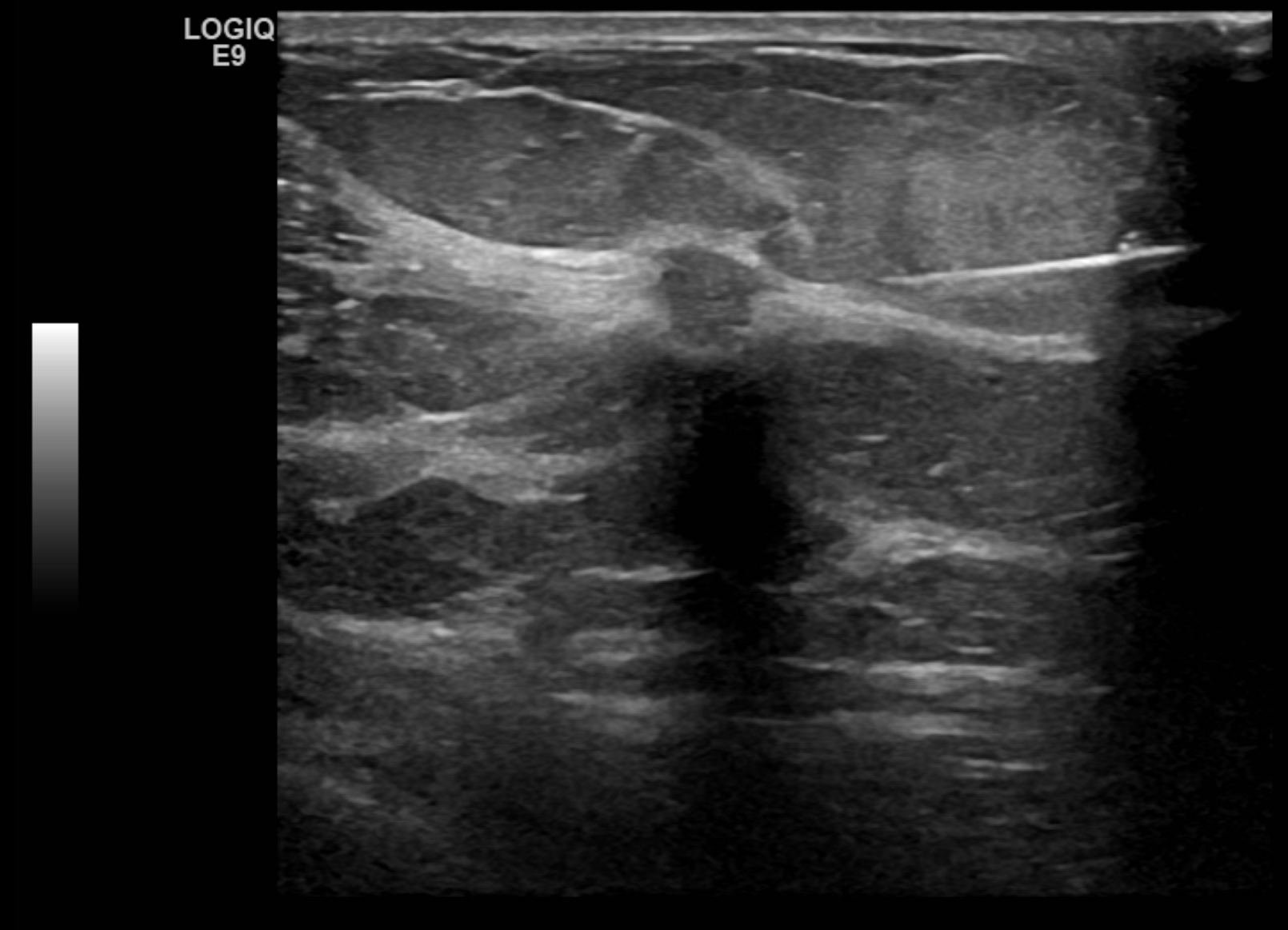 Ultrasound image of a right breast mass. Biopsy proven ductal carcinoma.