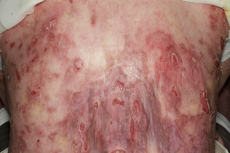 Truncal erosions and inflammation in Junctional Epidermolysis Bullosa.
