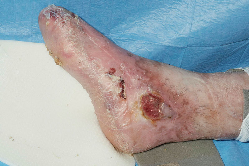 Pseudosyndactyly and ulceration of the lower limb in Recessive Dystrophic Epidermolysis Bullosa