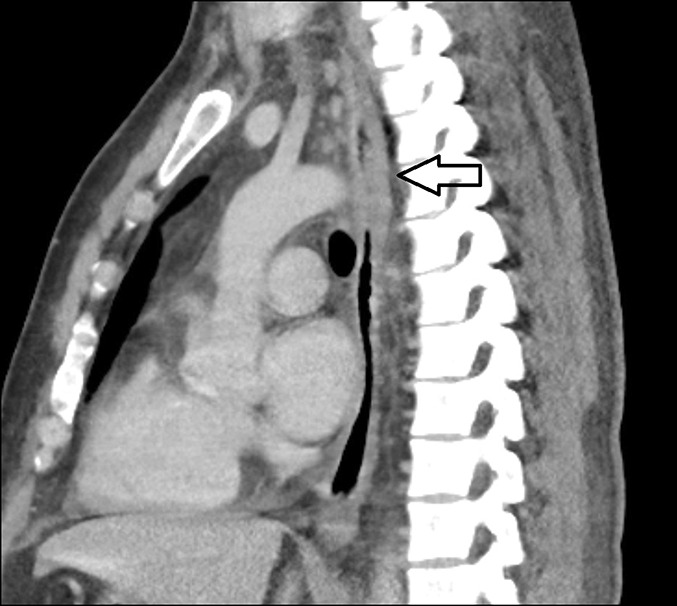 <p>Thickened Esophageal Walls. A computed tomography scan revealed thickened esophageal walls (arrow).</p>