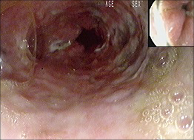<p>Ulcerated Esophagus. Endoscopy revealed multiple ulcers in the distal esophagus with erythematous and friable mucosa.</p>