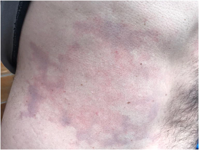 <p>Decompression Sickness Rash. Another photograph of the rash on patient&rsquo;s torso, a closer view.</p>