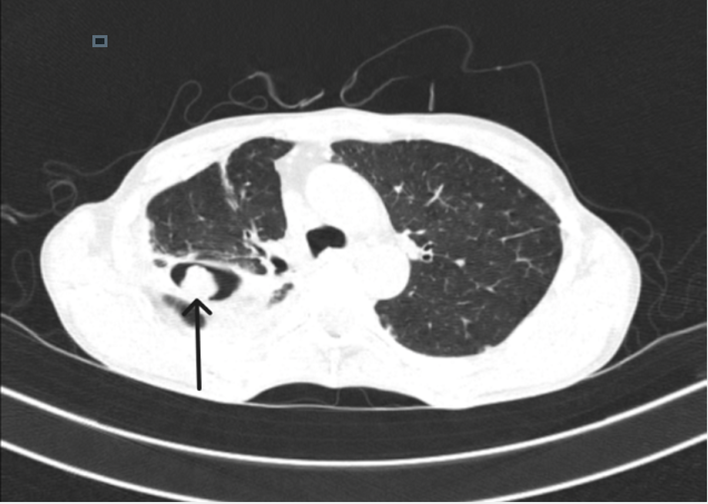 <p>CT Lung Showing Aspergilloma Mass That Indicates Monod's Sign
