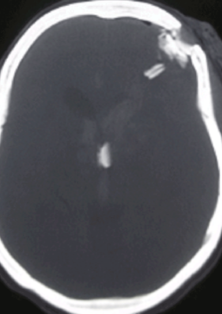 <p>Computed Tomography Of Non-Missile Penetrating Head Injury