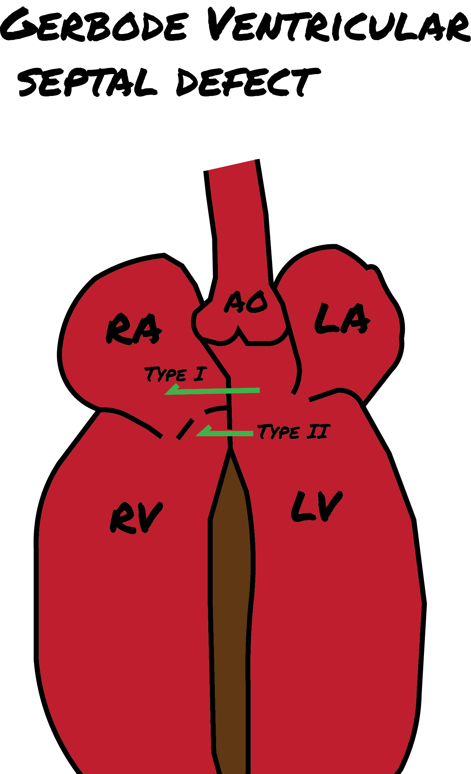 <p>Gerbode Defects. Illustration of the supra &amp; subvalvular defects seen in Gerbode ventricular septal defects.</p>