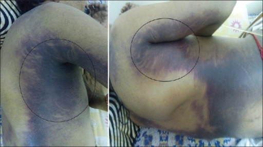 <p>Cutaneous Sign of Acute Pancreatitis. F1: Ecchymosis noted in the right axilla, which&nbsp;is deep blue in color.</p>