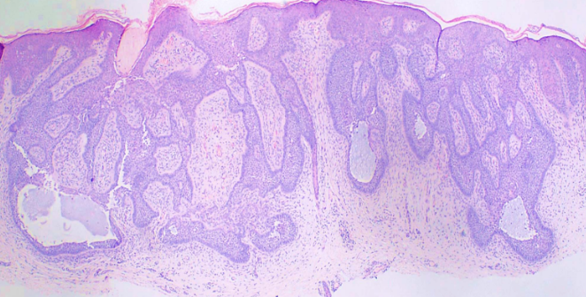 <p>Basal Cell Carcinoma, Fibroepithelioma of Pinkus</p>