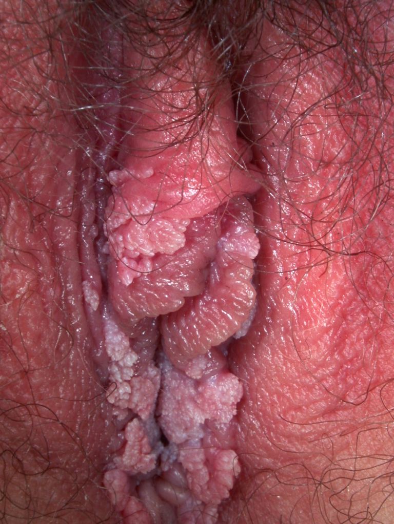 <p>Genital Warts, Female</p>