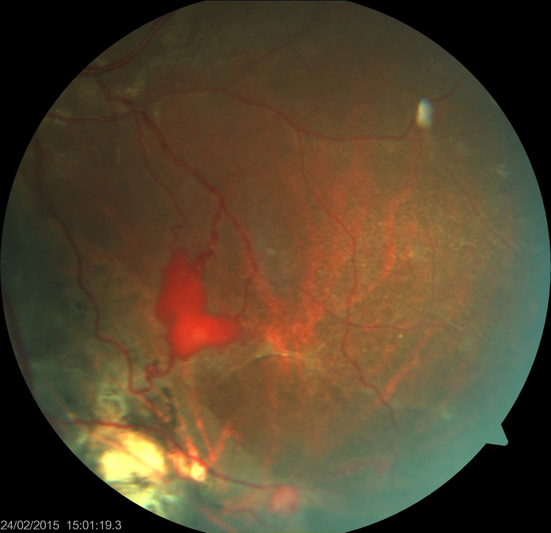 <p>Retinal Capillary Hemangioma
